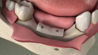 Dental Implants – Bone Grafting – Ridge Preservation in Denville, NJ