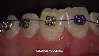 An easy way to place elastic tie by settling instrument in orthodontics by Dr. Amr Asker
