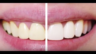 Flash Teeth Whitening – Teeth Whitening – Atlanta, GA